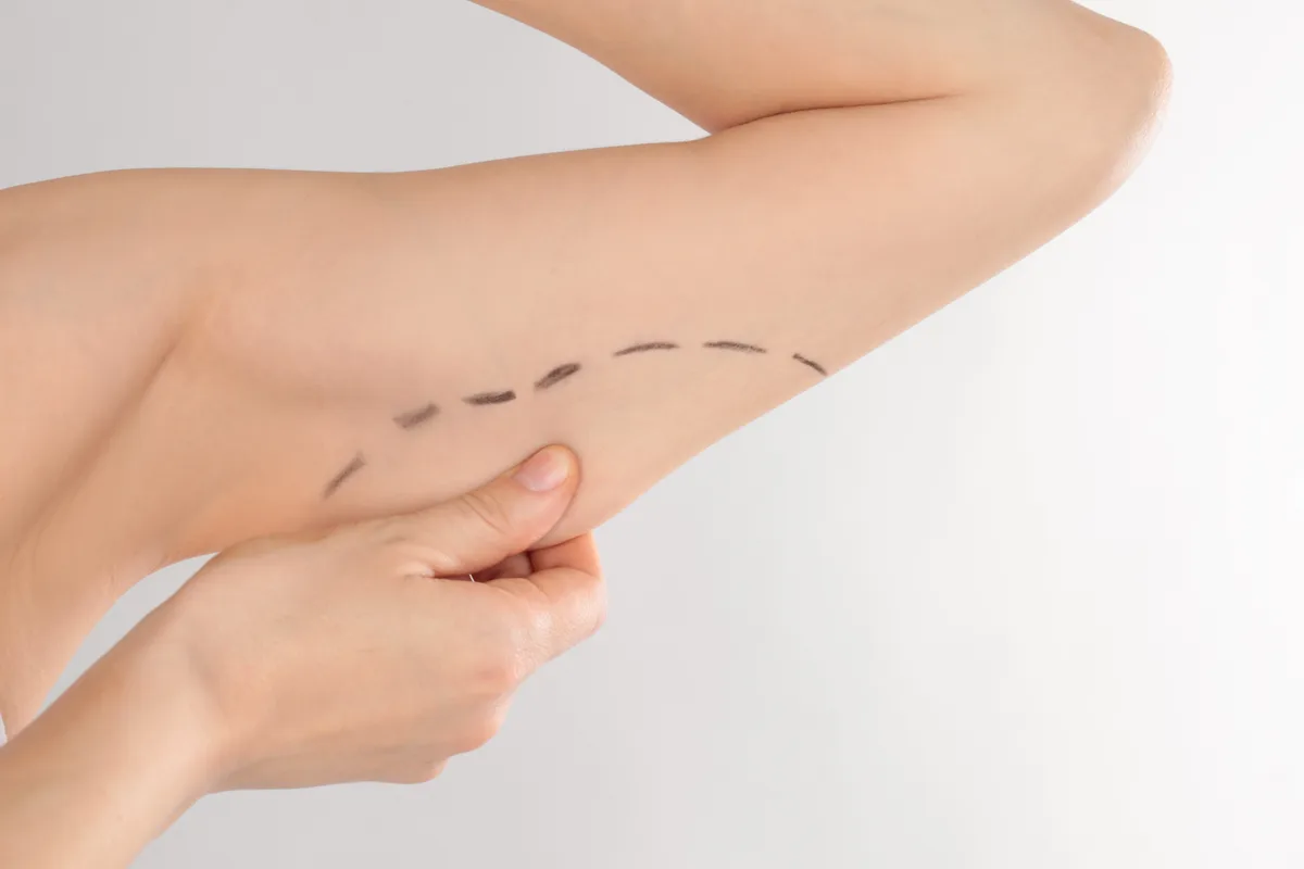 Arm Lift procedure at Russald Medical Center, Tijuana