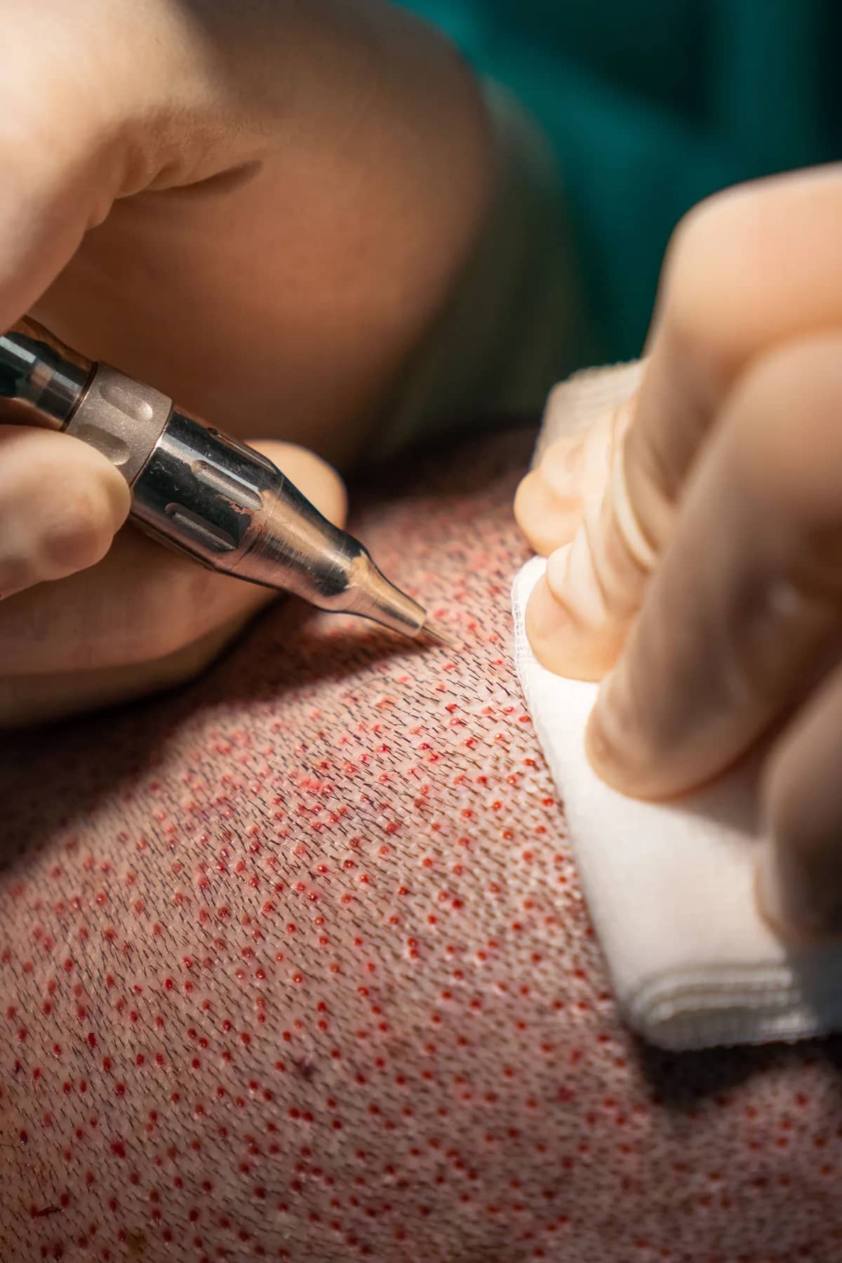 DHI Hair Transplant procedure at Russald Medical Center, Tijuana