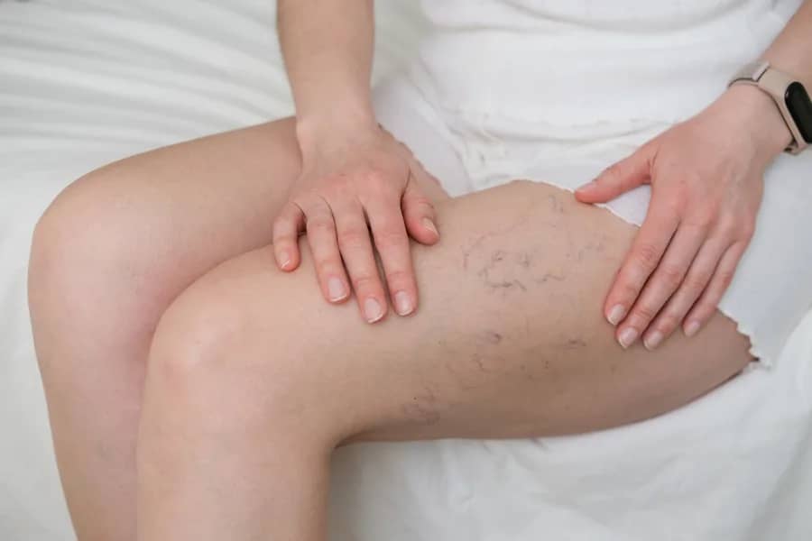 EVLA (Varicose Veins) procedure at Russald Medical Center, Tijuana
