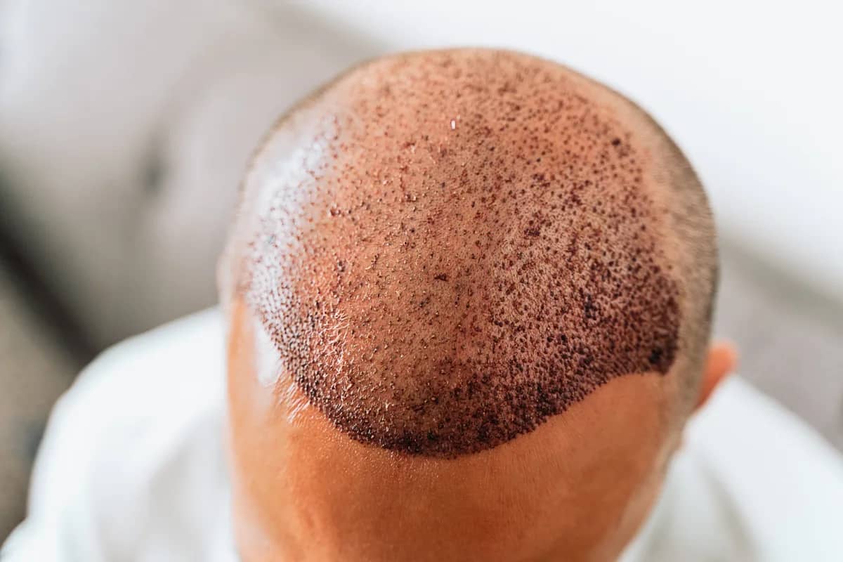 FUE Hair Transplant procedure at Russald Medical Center, Tijuana