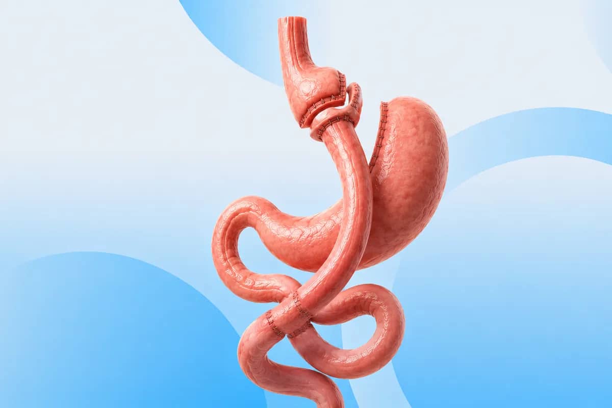 Gastric Bypass procedure at Russald Medical Center, Tijuana