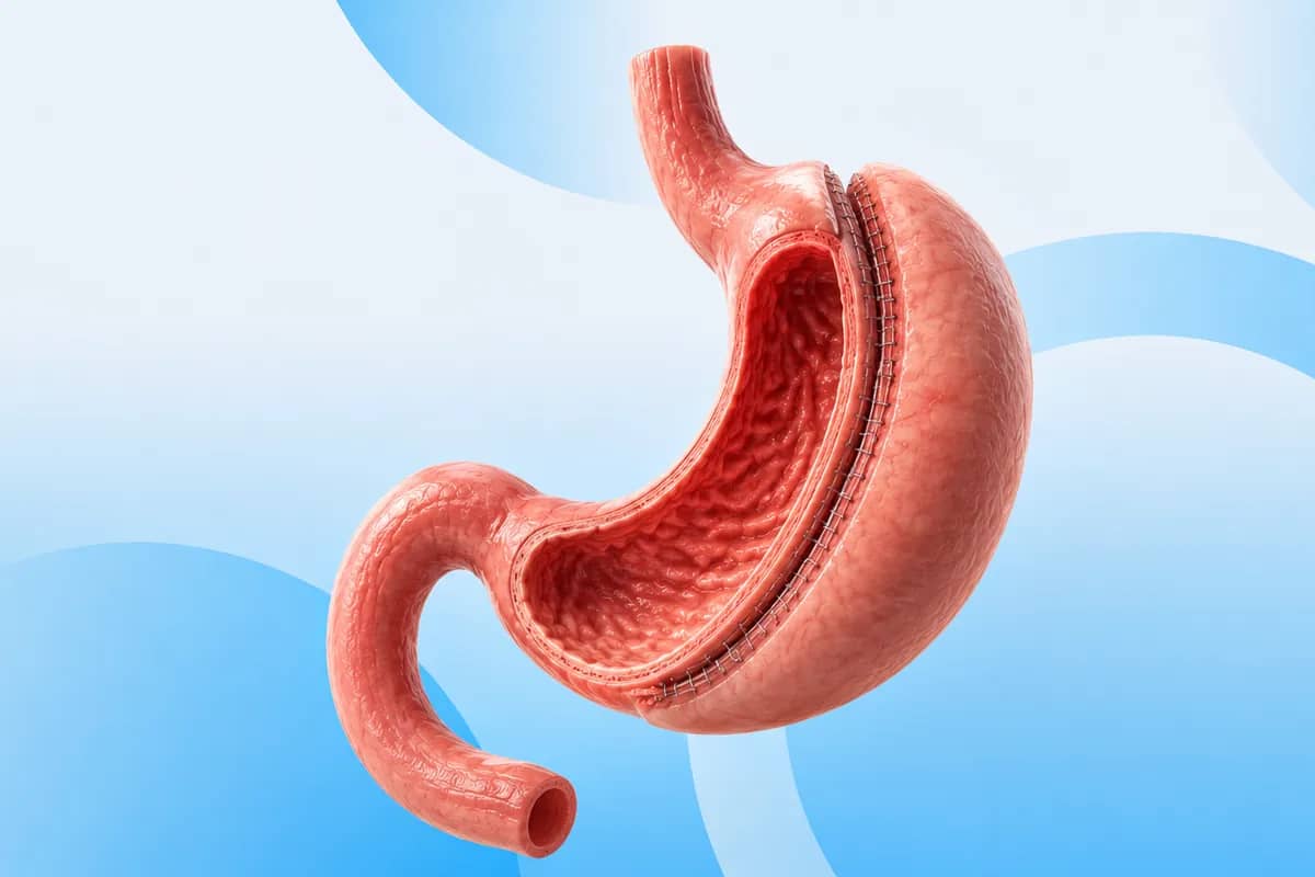 Gastric Sleeve procedure at Russald Medical Center, Tijuana