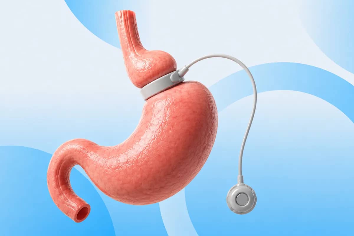 Lap-Band procedure at Russald Medical Center, Tijuana