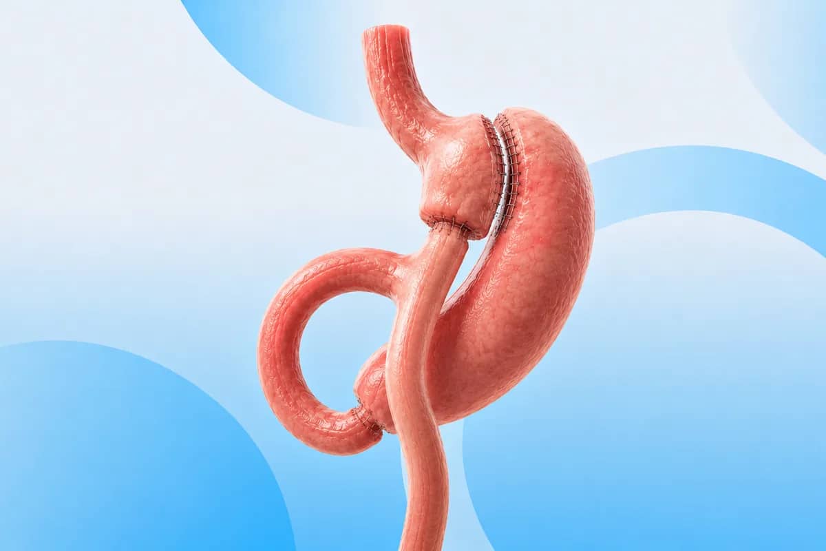 Mini Gastric Bypass procedure at Russald Medical Center, Tijuana