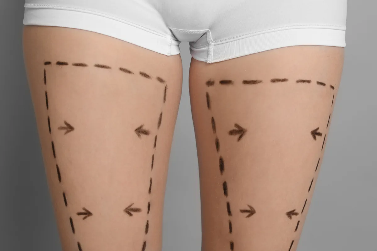 Thigh Lift procedure at Russald Medical Center, Tijuana