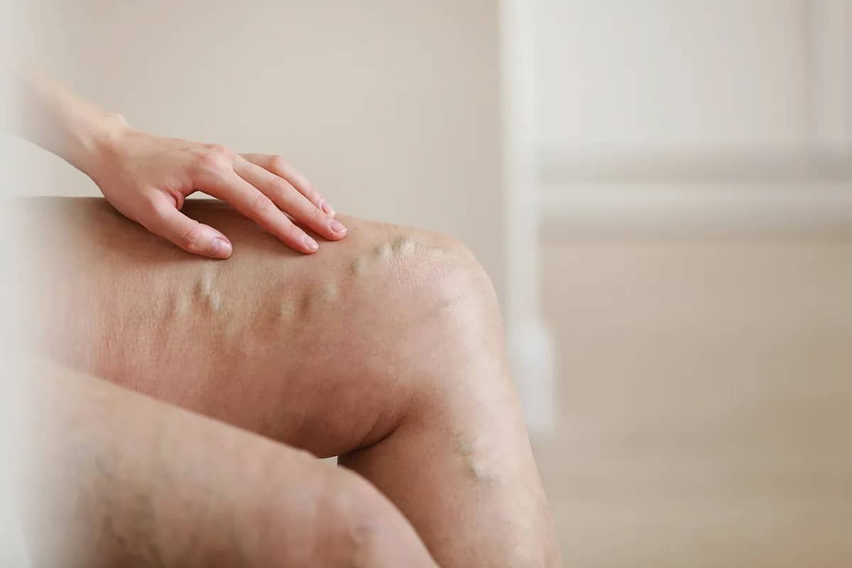 Vascular care treatment