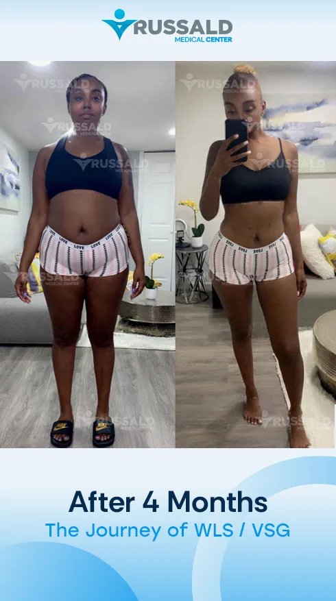 Gastric sleeve patient before and after, Russald Medical Center