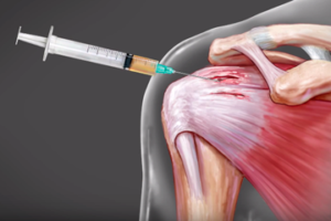 PRP Therapy (Injections) for Shoulder in Tijuana, Mexico
